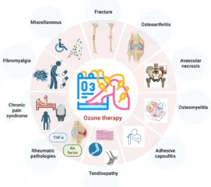 کاربرد های اوزون تراپی در بیماری های ارتوپدی به نقل از مجله : European Journal of Medical Research